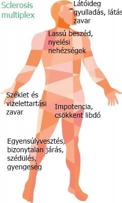 sclerosis multiplex és ízületi fájdalmak